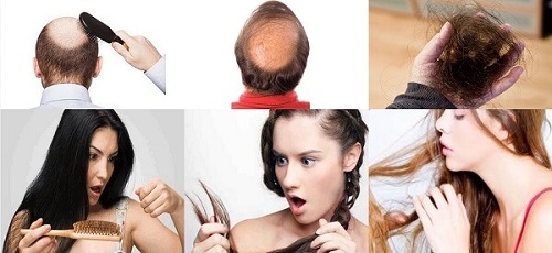 Có rất nhiều nguyên nhân gây rụng tóc và gây nên nhiều tình trạng tóc rụng khác nhau